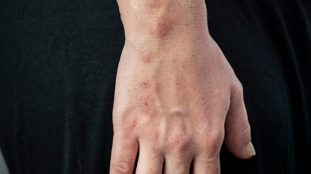 how to tell difference between mosquito bite and bed bug bite