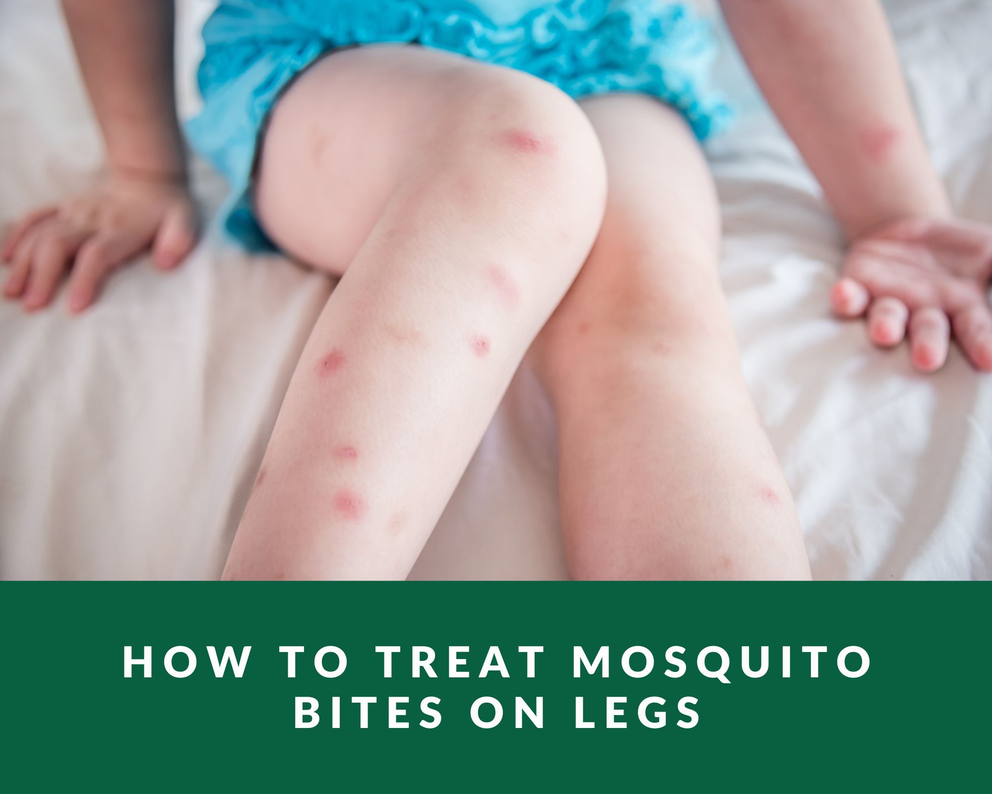 how-treat-mosquito-bites-on-legs