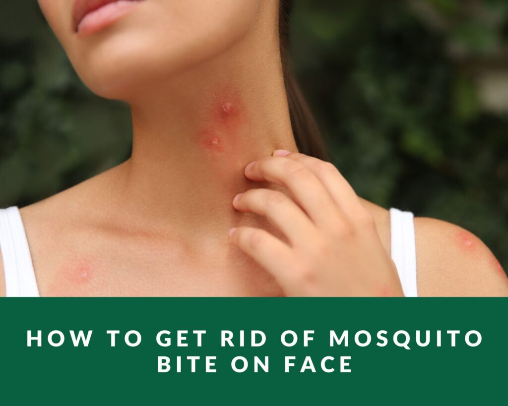 how-to-get-rid-of-mosquito-bite-on-face-zero-pest-ng