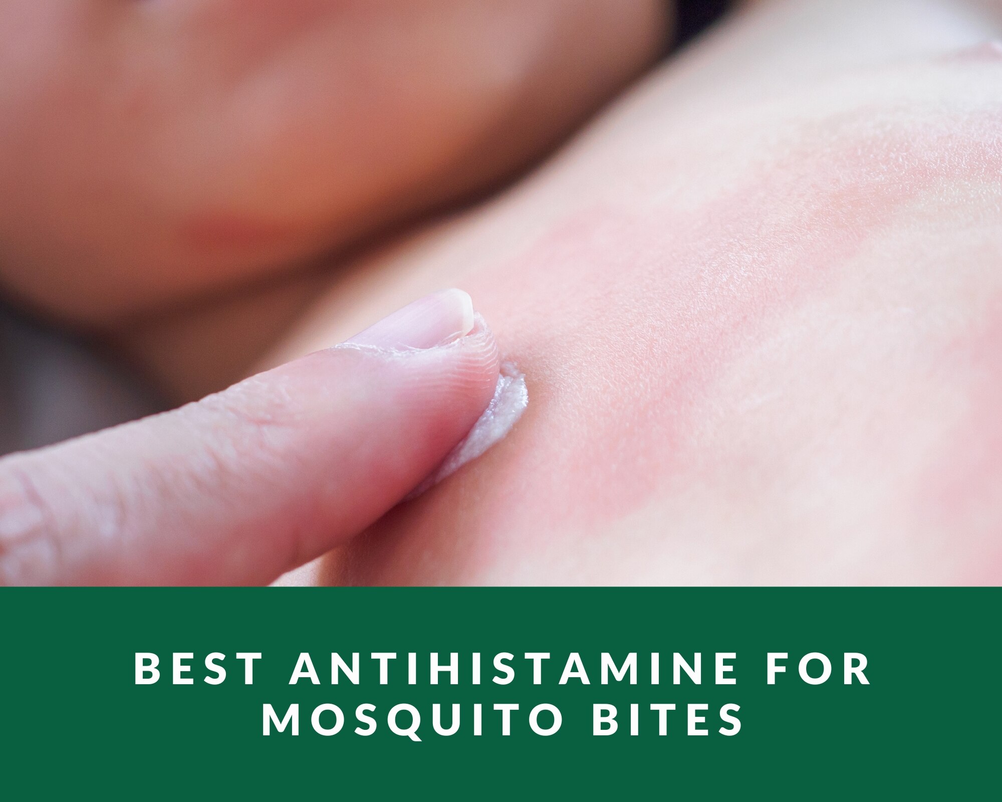 best antihistamine for mosquito bites