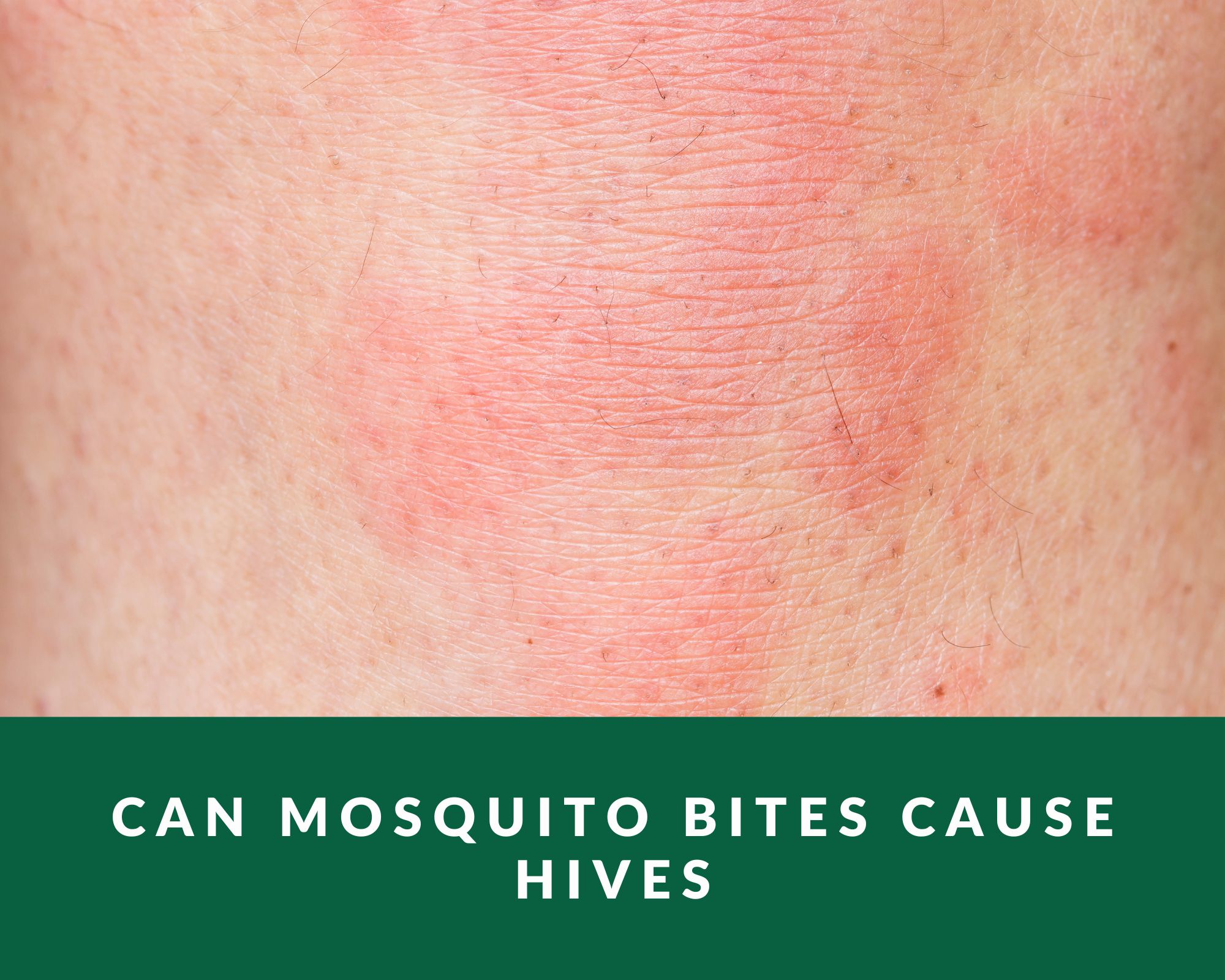 Can Mosquito Bites Cause Hives