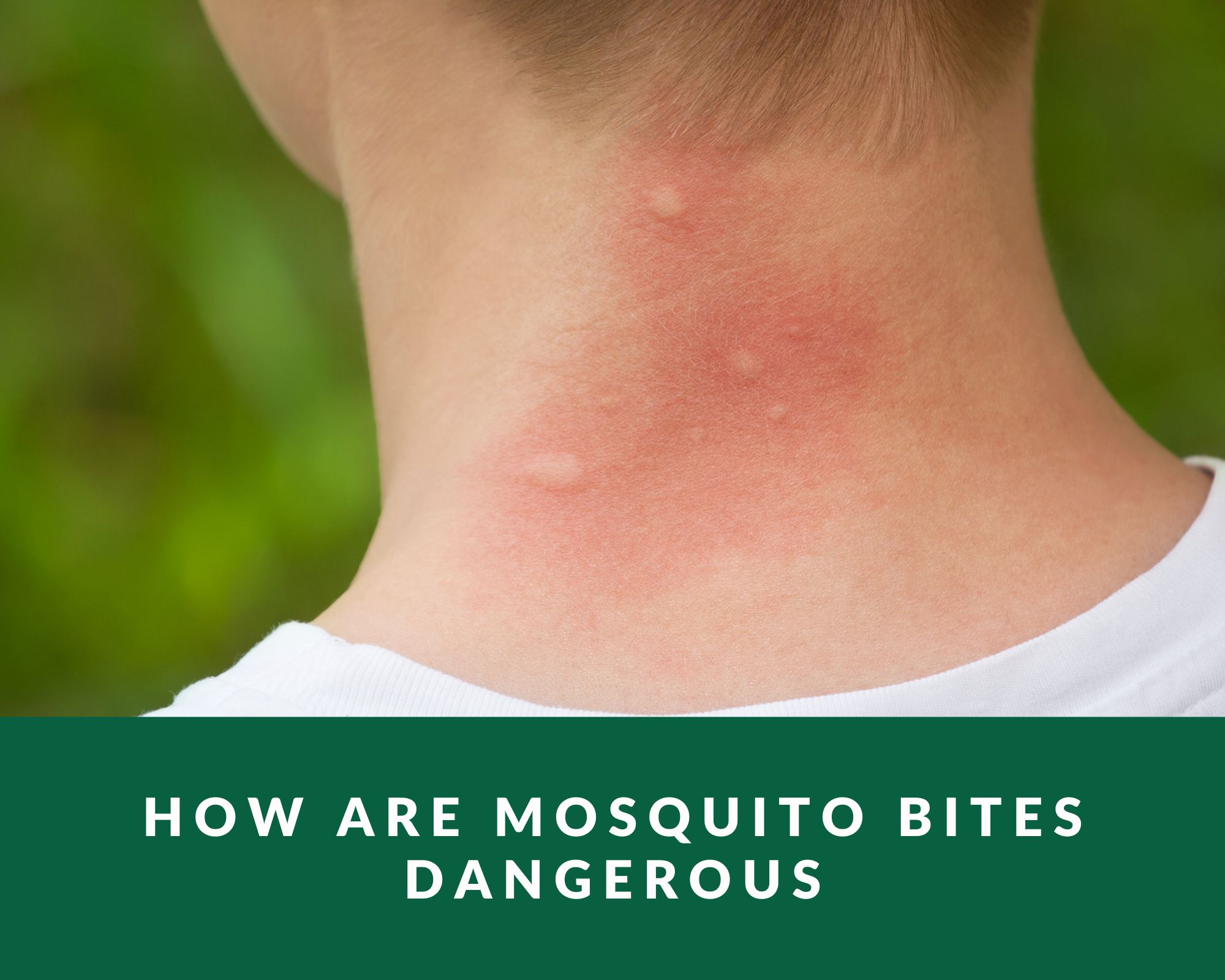 How Are Mosquito Bites Dangerous Zero Pest NG