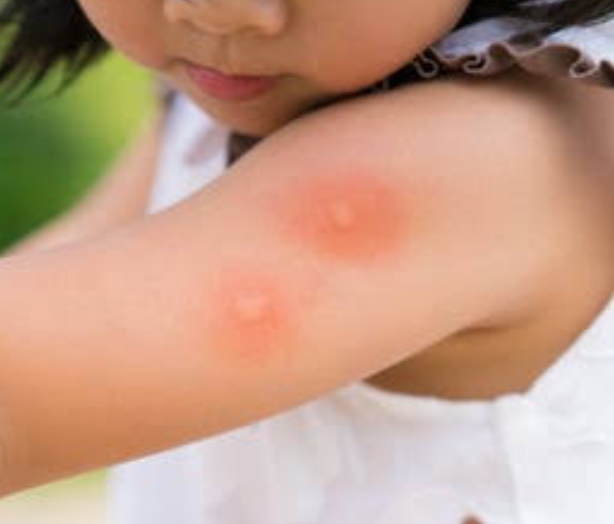 What to do for a mosquito bite allergy